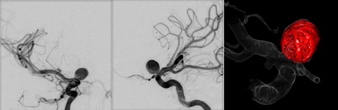 脳動脈瘤に対するコイル塞栓術
