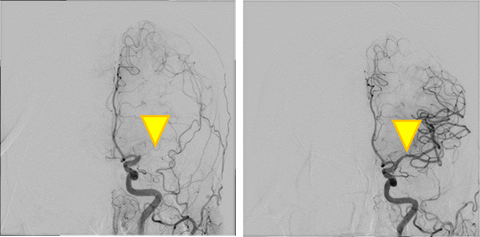脳梗塞に対する血栓回収療法