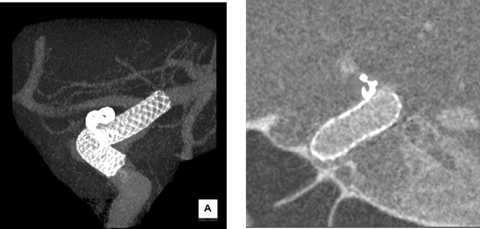 ステント留置術