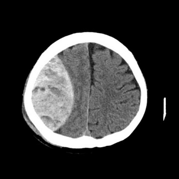 急性硬膜外血腫の画像
