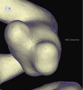 コンピュータによる脳動脈瘤内の血流シミュレーション（CFD）の画像