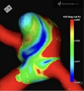 コンピュータによる脳動脈瘤内の血流シミュレーション（CFD）の画像