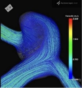 コンピュータによる脳動脈瘤内の血流シミュレーション（CFD）の画像3