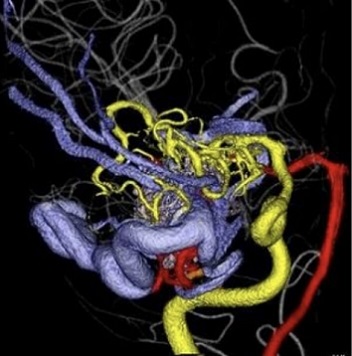 脳動静脈奇形の画像処理による3次元画像""