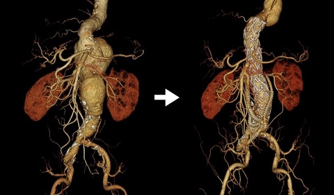 胸腹部大動脈瘤に対するハイブリッド手術（開腹腹部分枝再建＋血管内治療）画像