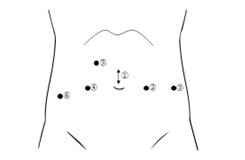 ロボット支援腹腔鏡下前立腺全摘除術
