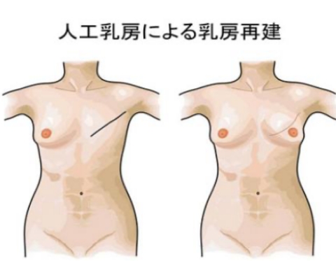 人口乳房による乳房再建