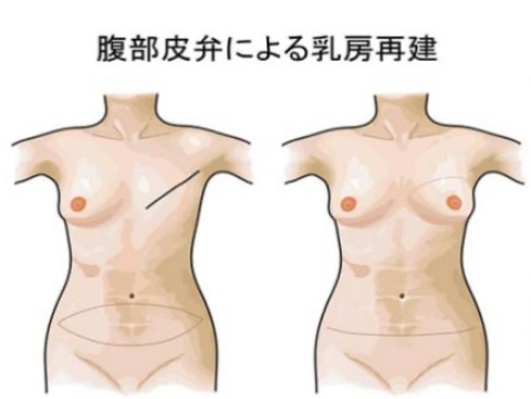 腹部皮弁による乳房再建