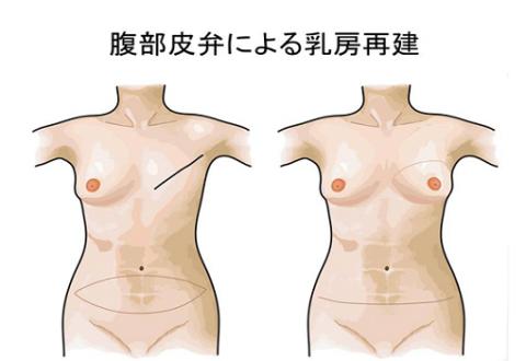 腹部皮弁による乳房再建