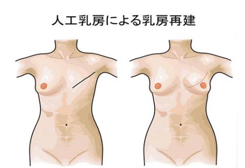 人口乳房による乳房再建