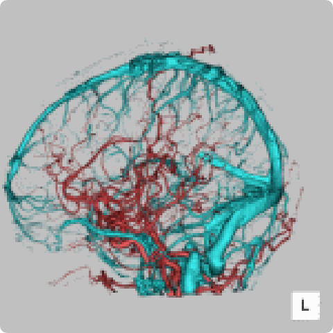 320列CT装置で得られる脳血管画像