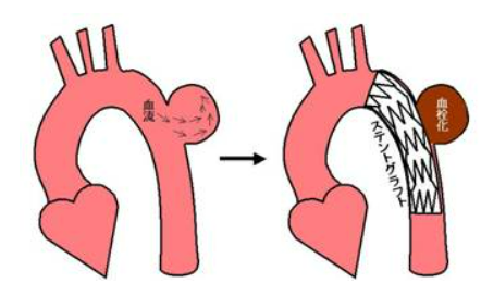 ステントグラフト内挿術のイラスト