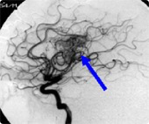 脳動静脈奇形治療前の画像