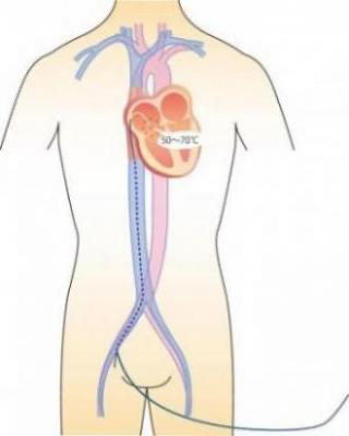 心臓と大動脈および大静脈のイメージ