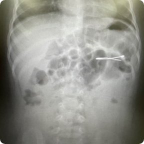 胃内異物のレントゲン写真
